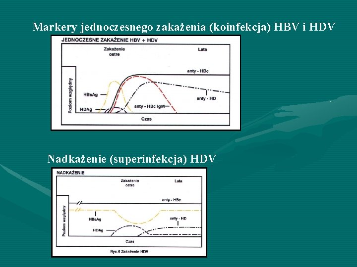 Markery jednoczesnego zakażenia (koinfekcja) HBV i HDV Nadkażenie (superinfekcja) HDV 