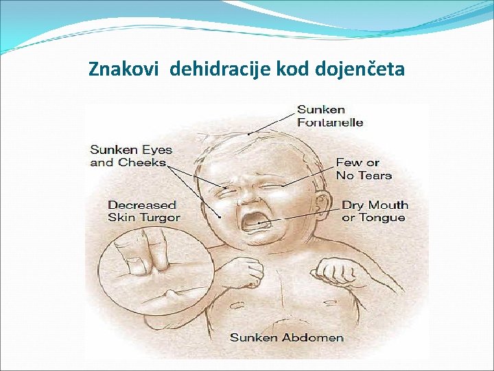 Znakovi dehidracije kod dojenčeta 