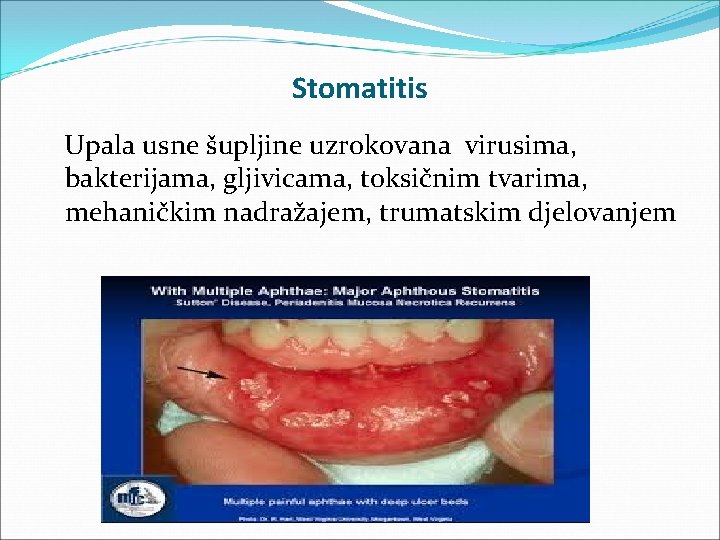 Stomatitis Upala usne šupljine uzrokovana virusima, bakterijama, gljivicama, toksičnim tvarima, mehaničkim nadražajem, trumatskim djelovanjem