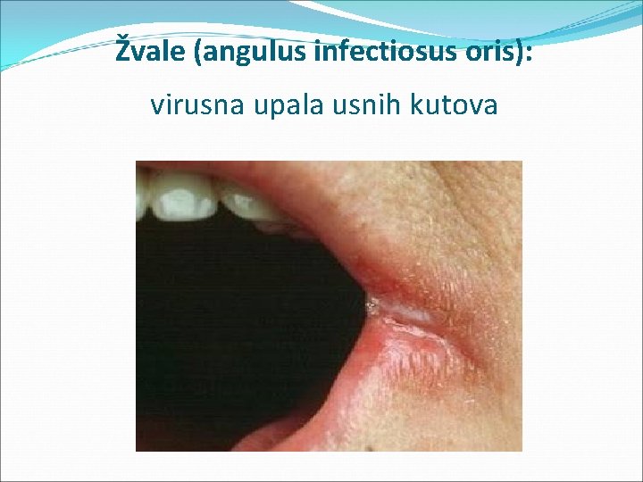 Žvale (angulus infectiosus oris): virusna upala usnih kutova 