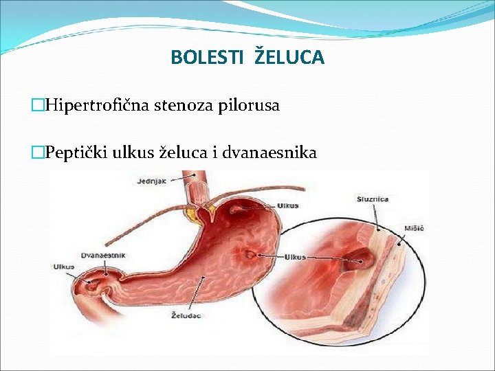 BOLESTI ŽELUCA �Hipertrofična stenoza pilorusa �Peptički ulkus želuca i dvanaesnika 