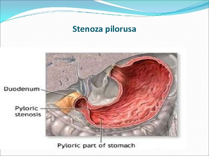 Stenoza pilorusa 