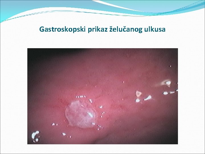 Gastroskopski prikaz želučanog ulkusa 