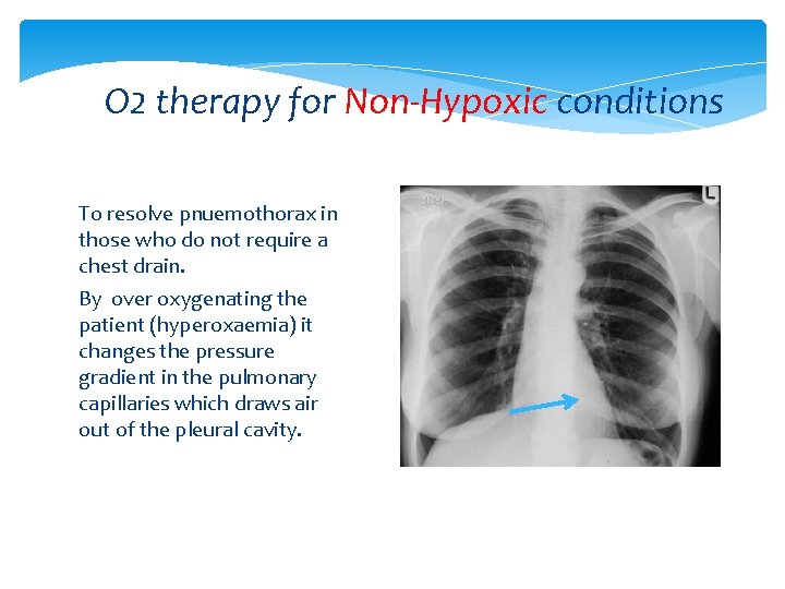 O 2 therapy for Non-Hypoxic conditions To resolve pnuemothorax in those who do not