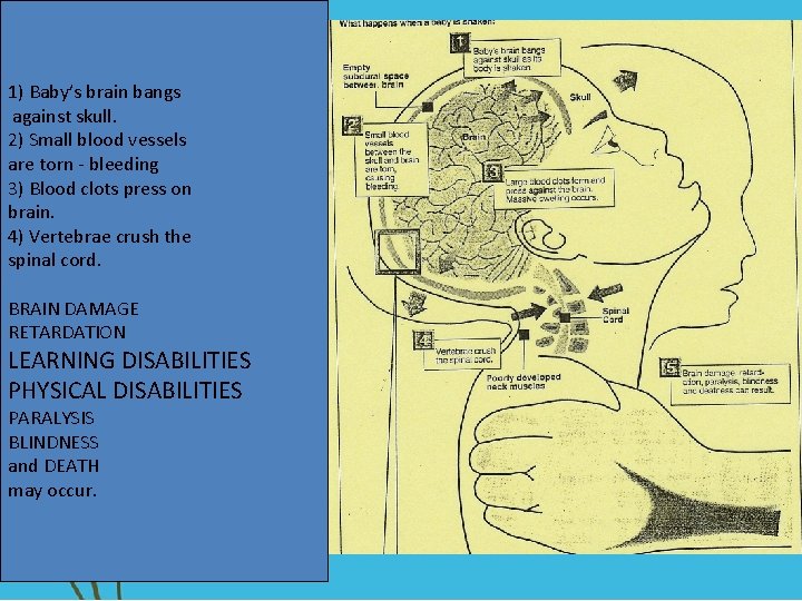 1) Baby’s brain bangs against skull. 2) Small blood vessels are torn - bleeding