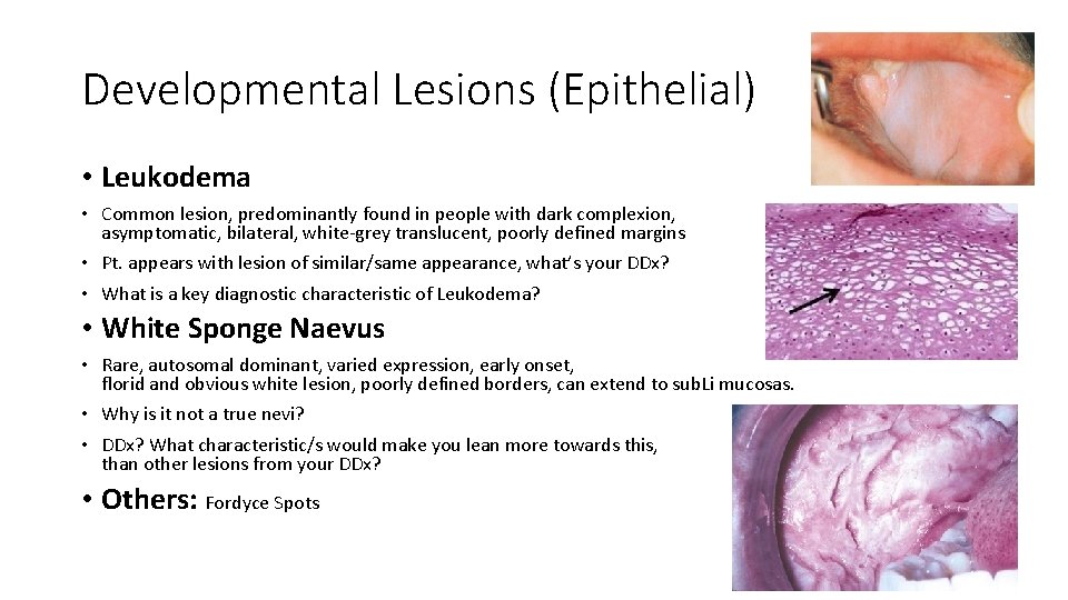 Developmental Lesions (Epithelial) • Leukodema • Common lesion, predominantly found in people with dark Developmental Lesions (Epithelial) • Leukodema • Common lesion, predominantly found in people with dark