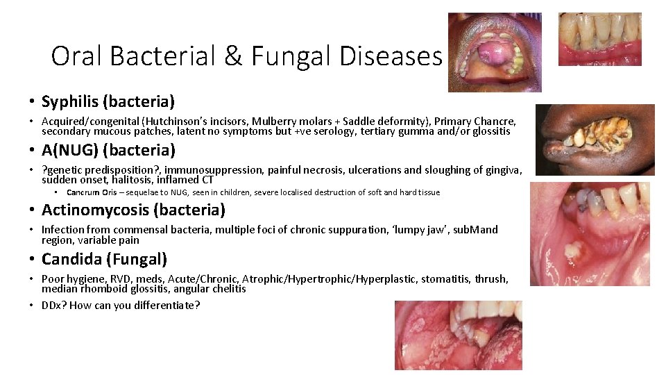 Oral Bacterial & Fungal Diseases • Syphilis (bacteria) • Acquired/congenital (Hutchinson’s incisors, Mulberry molars Oral Bacterial & Fungal Diseases • Syphilis (bacteria) • Acquired/congenital (Hutchinson’s incisors, Mulberry molars