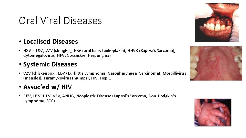 Oral Viral Diseases • Localised Diseases • HSV – 1&2, VZV (shingles), EBV (oral Oral Viral Diseases • Localised Diseases • HSV – 1&2, VZV (shingles), EBV (oral