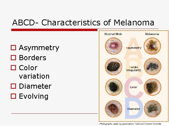 ABCD- Characteristics of Melanoma o Asymmetry o Borders o Color variation o Diameter o