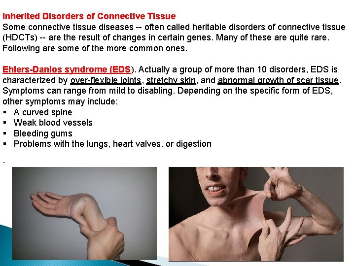 Inherited Disorders of Connective Tissue Some connective tissue diseases -- often called heritable disorders