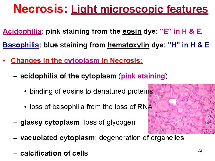 Necrosis: Necrosis Light microscopic features Acidophilia: pink staining from the eosin dye: "E" in