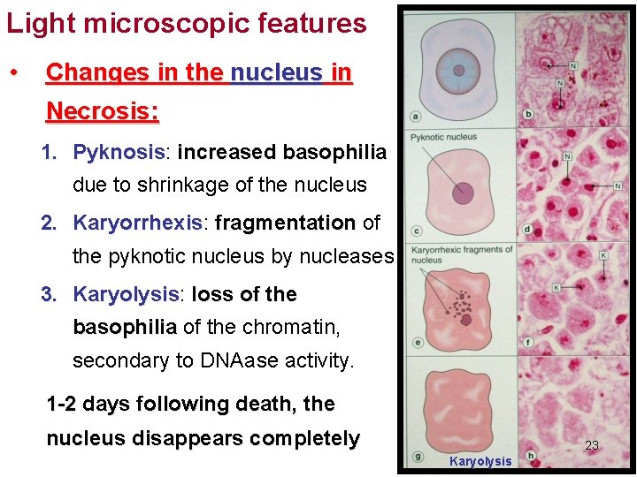 Light microscopic features • Changes in the nucleus in Necrosis: 1. Pyknosis: Pyknosis increased