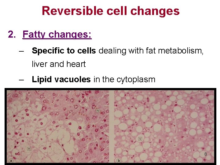 Reversible cell changes 2. Fatty changes: – Specific to cells dealing with fat metabolism,