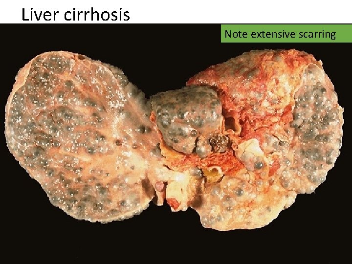 Liver cirrhosis Note extensive scarring 