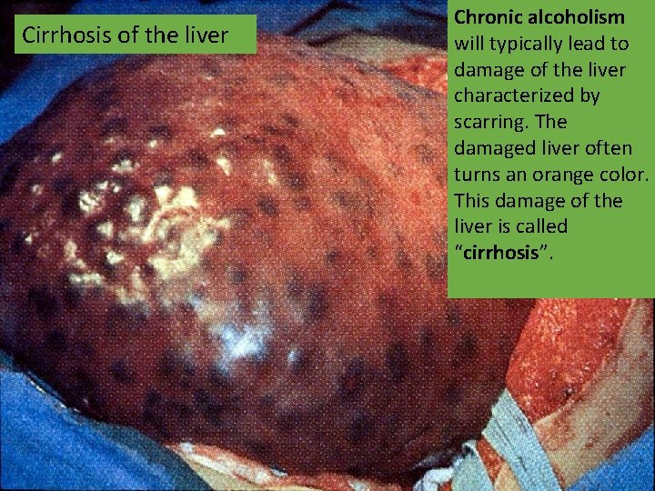 Cirrhosis of the liver Chronic alcoholism will typically lead to damage of the liver