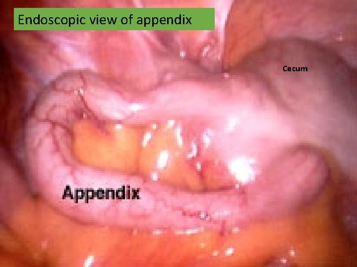 Endoscopic view of appendix Cecum 