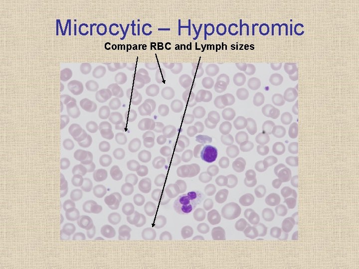 Microcytic – Hypochromic Compare RBC and Lymph sizes 