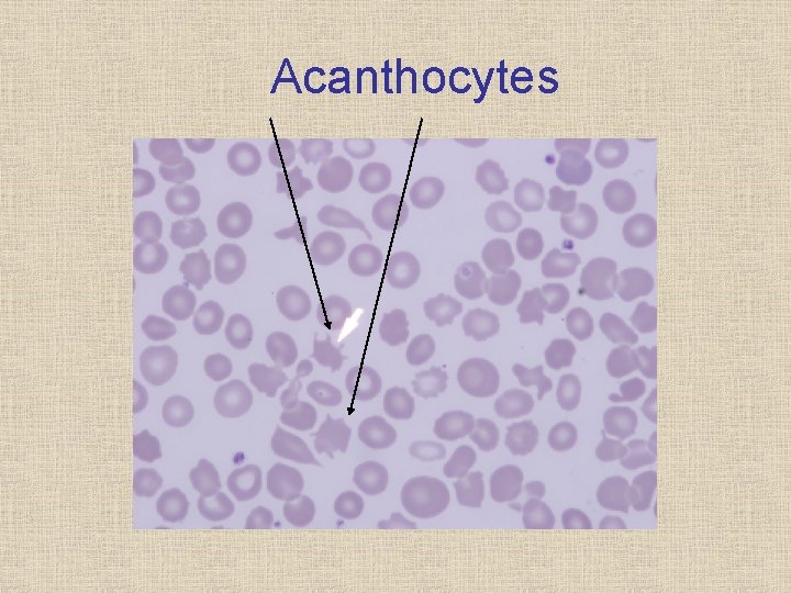 Acanthocytes 