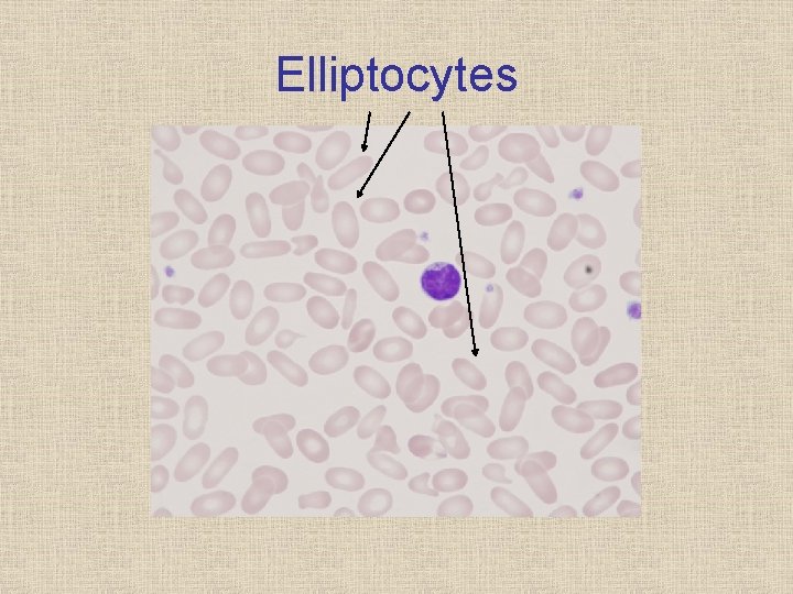 Elliptocytes 