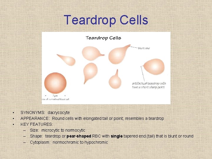 Teardrop Cells • • • SYNONYMS: dacrycocyte APPEARANCE: Round cells with elongated tail or