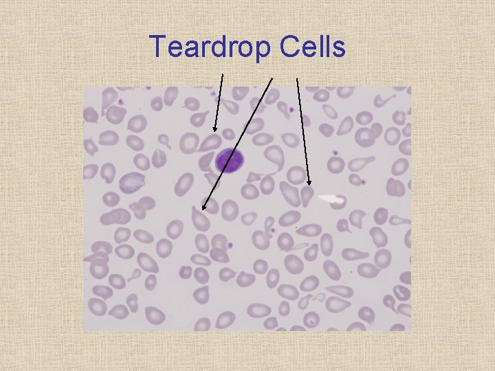 Teardrop Cells 