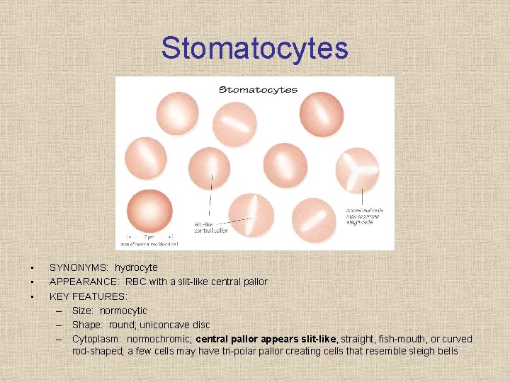 Stomatocytes • • • SYNONYMS: hydrocyte APPEARANCE: RBC with a slit like central pallor