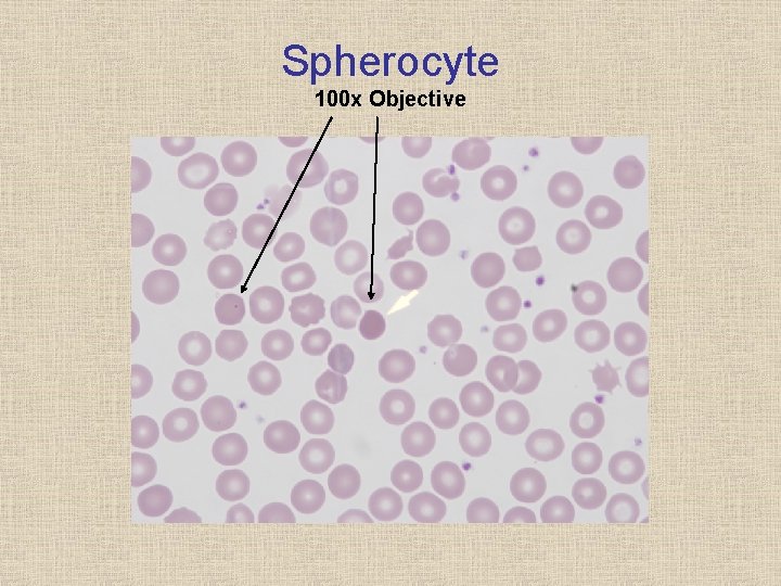 Spherocyte 100 x Objective 
