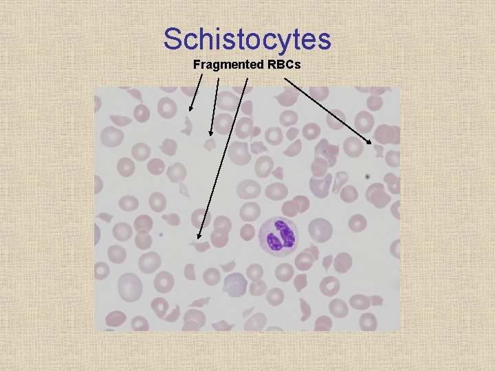 Schistocytes Fragmented RBCs 
