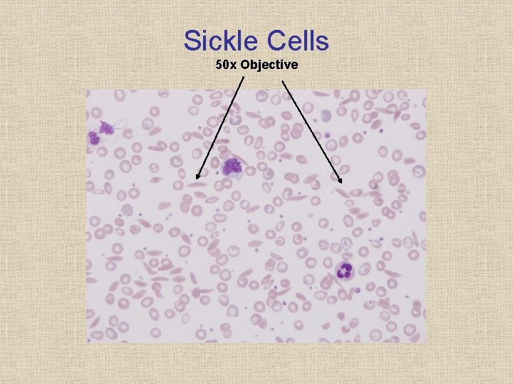 Sickle Cells 50 x Objective 