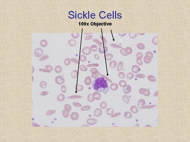 Sickle Cells 100 x Objective 