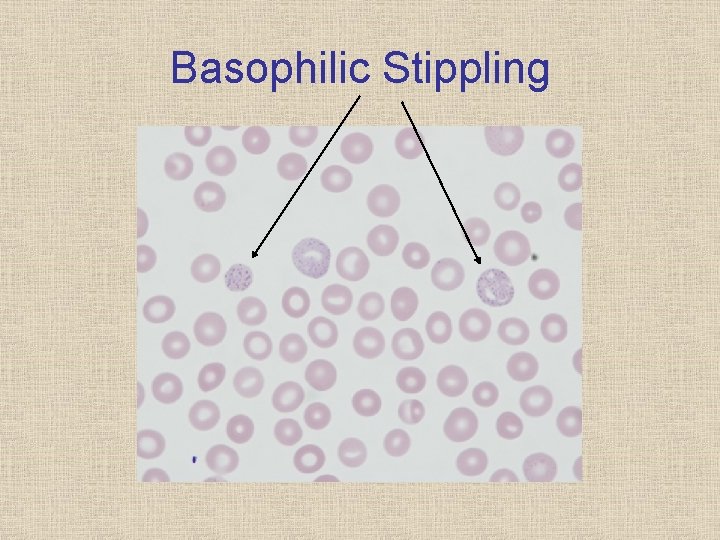 Basophilic Stippling 