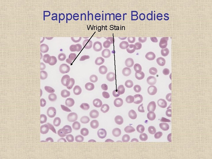 Pappenheimer Bodies Wright Stain 