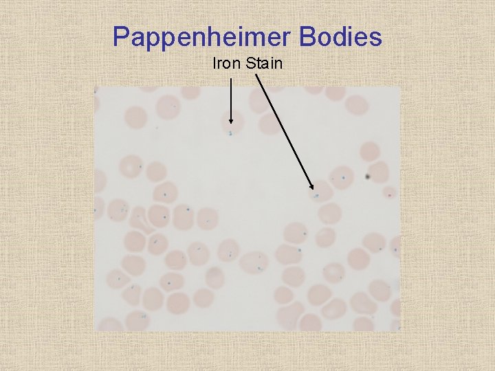 Pappenheimer Bodies Iron Stain 