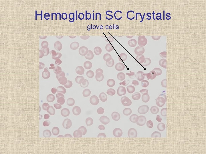 Hemoglobin SC Crystals glove cells 