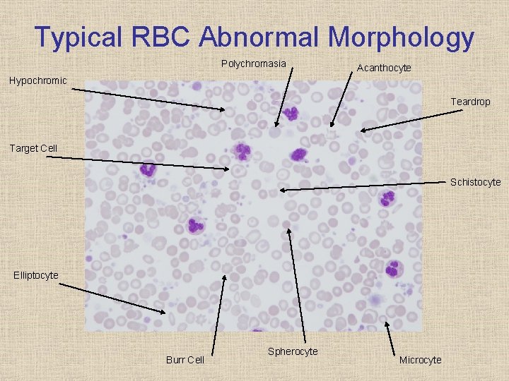 Typical RBC Abnormal Morphology Polychromasia Acanthocyte Hypochromic Teardrop Target Cell Schistocyte Elliptocyte Burr Cell