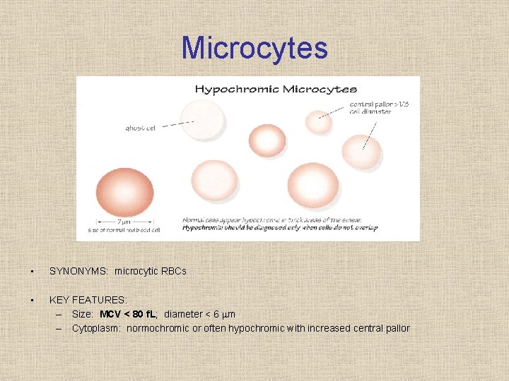 Microcytes • SYNONYMS: microcytic RBCs • KEY FEATURES: – Size: MCV < 80 f.