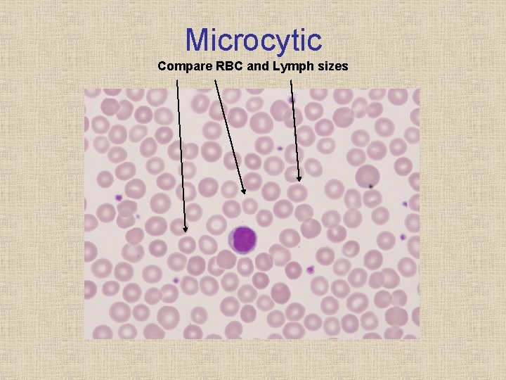 Microcytic Compare RBC and Lymph sizes 