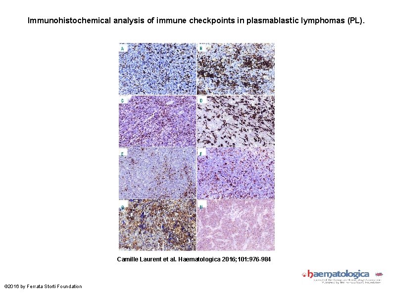 Immunohistochemical analysis of immune checkpoints in plasmablastic lymphomas (PL). Camille Laurent et al. Haematologica