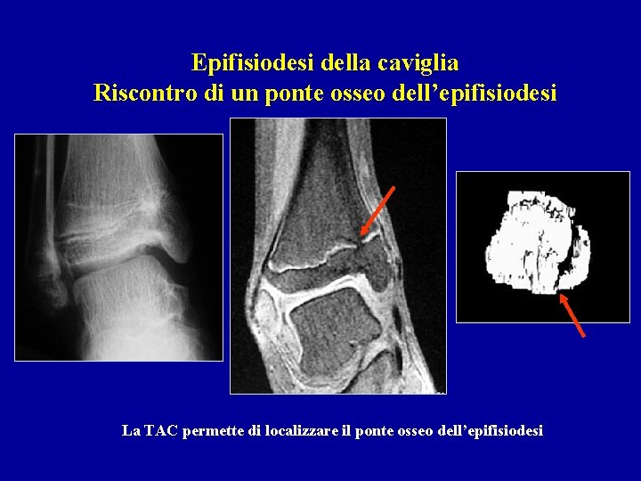 Epifisiodesi della caviglia Riscontro di un ponte osseo dell’epifisiodesi La TAC permette di localizzare