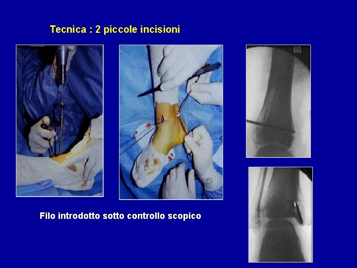 Tecnica : 2 piccole incisioni Filo introdotto sotto controllo scopico 