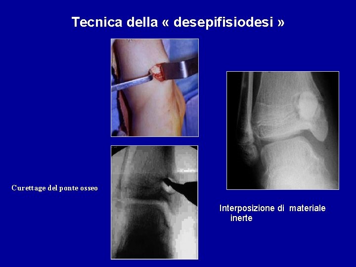 Tecnica della « desepifisiodesi » Curettage del ponte osseo Interposizione di materiale inerte 