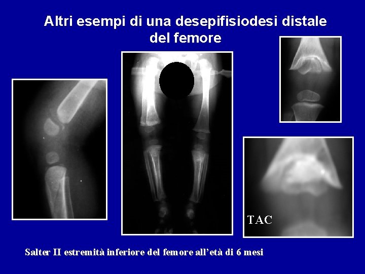 Altri esempi di una desepifisiodesi distale del femore TAC Salter II estremità inferiore del