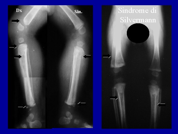 Dx Sindrome di Silvermann 