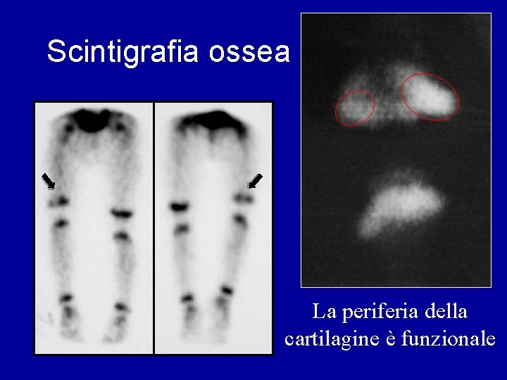 Scintigrafia ossea La periferia della cartilagine è funzionale 