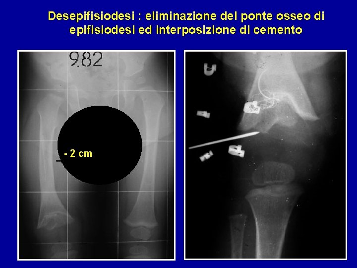 Desepifisiodesi : eliminazione del ponte osseo di epifisiodesi ed interposizione di cemento - 2