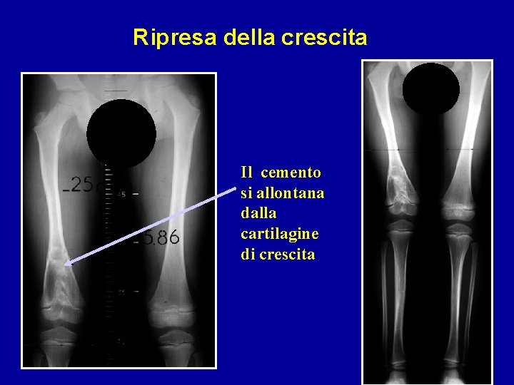 Ripresa della crescita Il cemento si allontana dalla cartilagine di crescita 