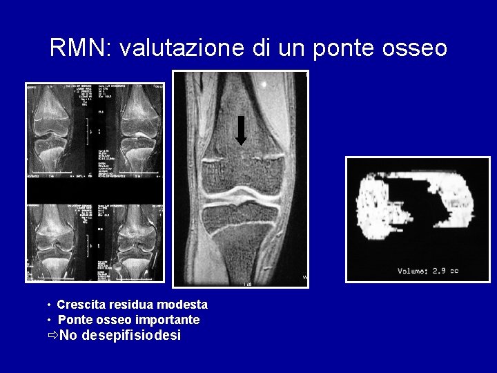 RMN: valutazione di un ponte osseo • Crescita residua modesta • Ponte osseo importante