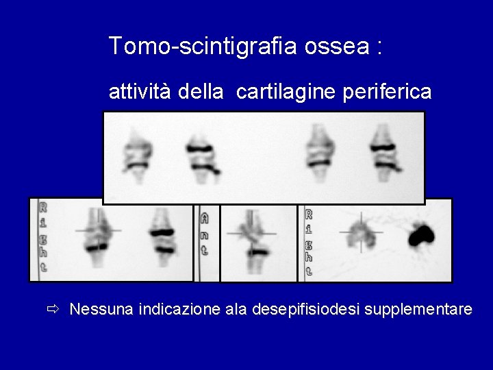 Tomo-scintigrafia ossea : attività della cartilagine periferica ð Nessuna indicazione ala desepifisiodesi supplementare 