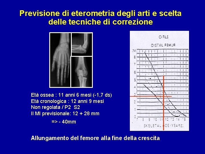 Previsione di eterometria degli arti e scelta delle tecniche di correzione Età ossea :