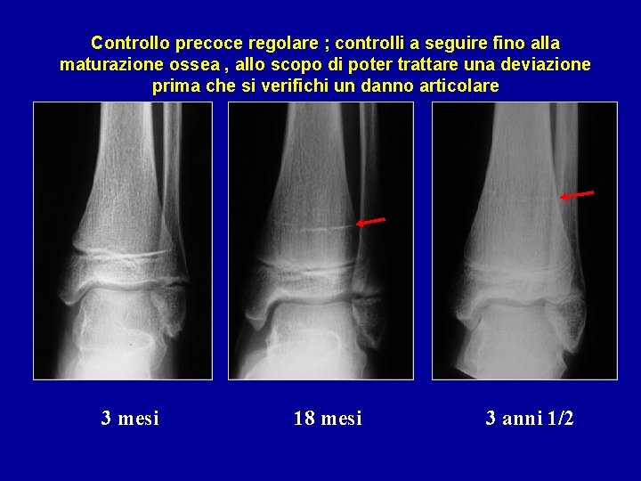 Controllo precoce regolare ; controlli a seguire fino alla maturazione ossea , allo scopo